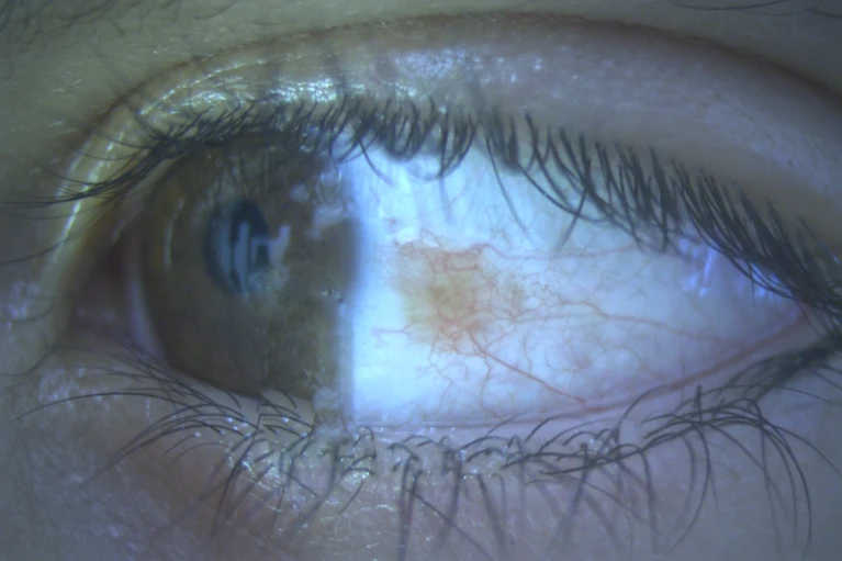 Imagen clínica de la superficie ocular observada en exploración oftalmológica para valorar el estado de la córnea y la conjuntiva.