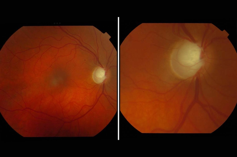 Retinografía de control de glaucoma que muestra el detalle del nervio óptico y la excavación papilar; diagnóstico avanzado para el seguimiento de la salud ocular en Oftalmediq.
